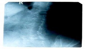 spinal x ray